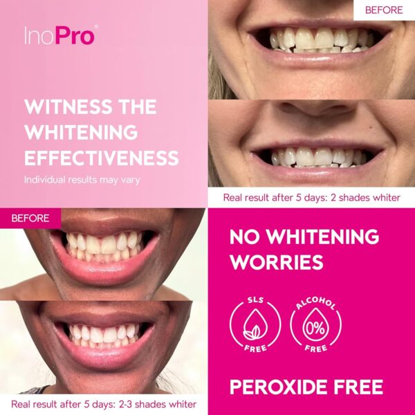 Teeth Whitening Strips 14 Treatments Kit - Teeth Whitener, - Image 4
